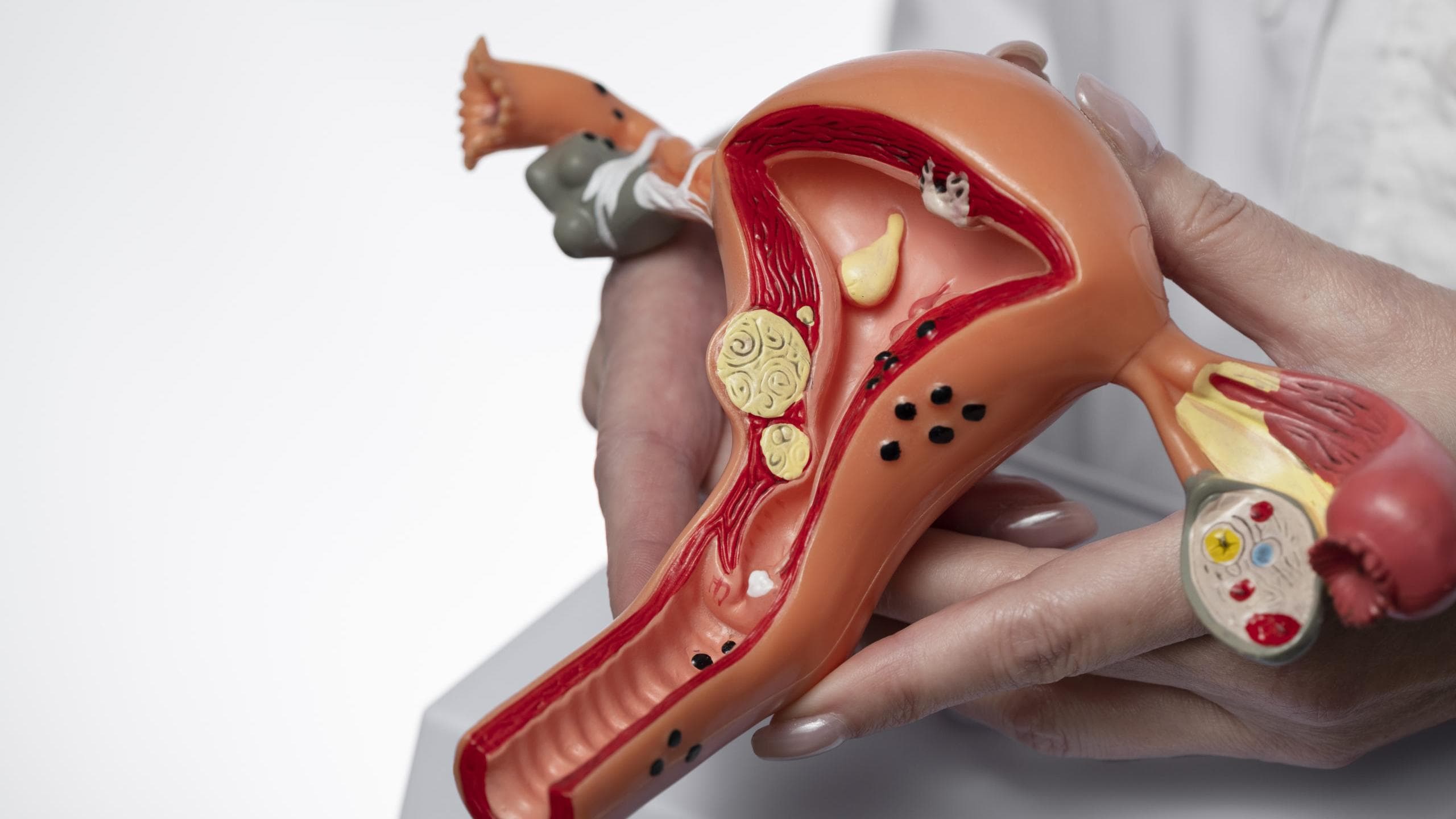 الأورام الليفية الرحمية غير مؤذية ولا تتحول إلى سرطانية.. ما الذي تعرفينه عن الليفات؟